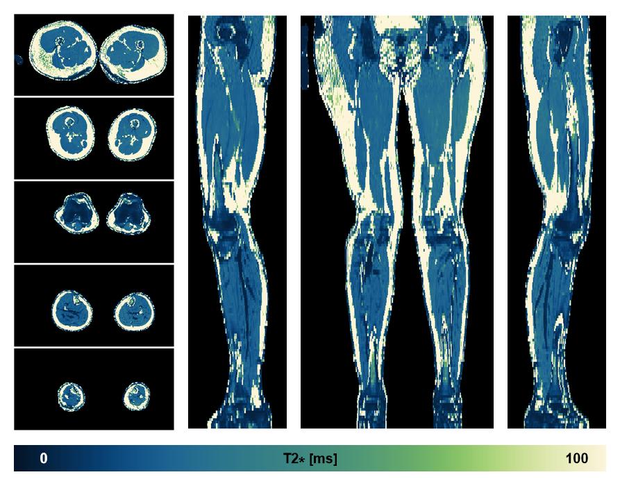 The T2 star relaxation time of the lower extremity obtained from the dixon reconstruction for muscle water fat quantification.